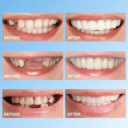 SNAP - ON SMILE Carillas dentales con clip - The Box Spain