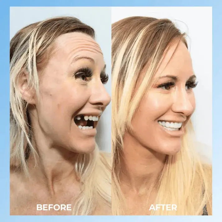 SNAP - ON SMILE Carillas dentales con clip - The Box Spain