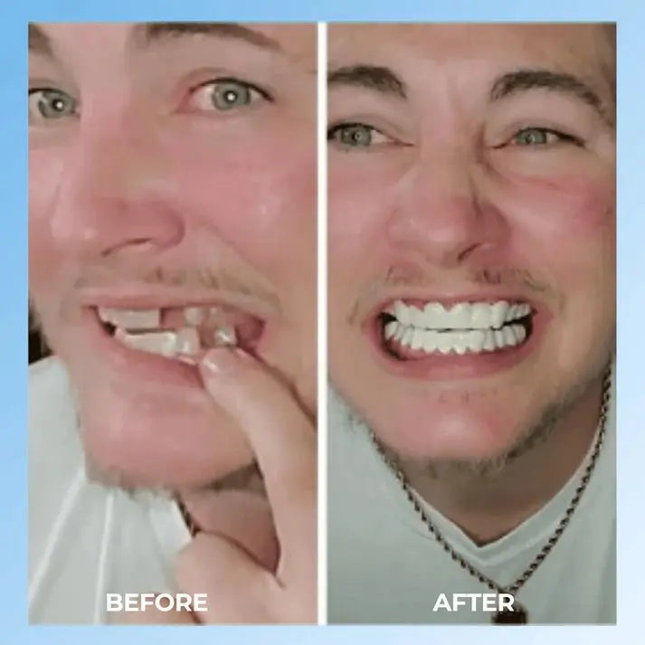 SNAP - ON SMILE Carillas dentales con clip - The Box Spain
