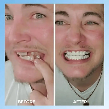 SNAP - ON SMILE Carillas dentales con clip - The Box Spain